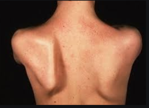 Anterior serratus muscle out of balance