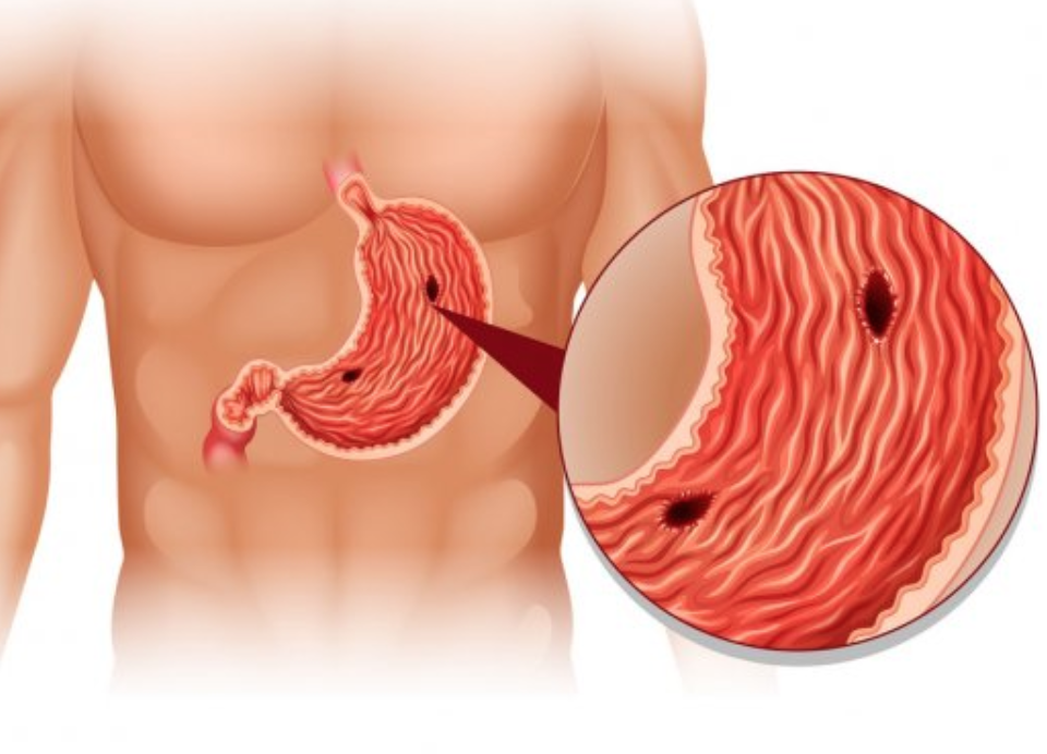 Stomach Ulcer